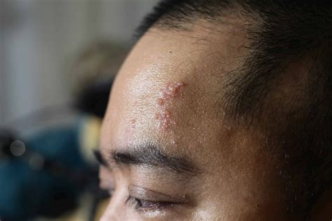 Nakahahawa ba ang pagkakaroon ng shingles o .